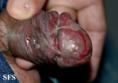behçet's syndrome
