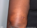 leprosy indeterminate