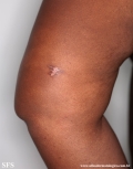 leprosy indeterminate