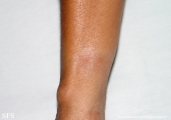 leprosy indeterminate