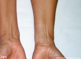leprosy indeterminate