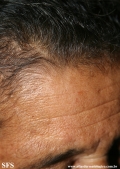 leprosy indeterminate