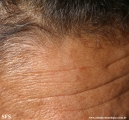 leprosy indeterminate