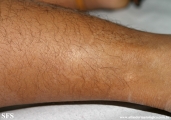 leprosy indeterminate
