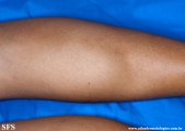 leprosy indeterminate