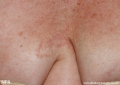 leprosy indeterminate