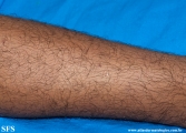 leprosy indeterminate