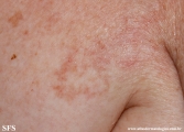 leprosy indeterminate
