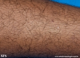 leprosy indeterminate