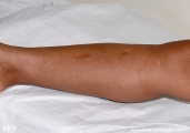 leprosy indeterminate