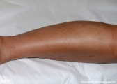 leprosy indeterminate