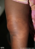 leprosy indeterminate