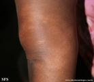 leprosy indeterminate