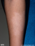 leprosy indeterminate