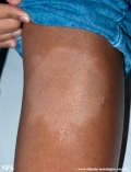 leprosy indeterminate