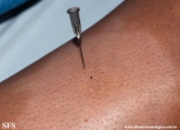 leprosy indeterminate
