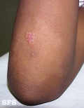 leprosy indeterminate