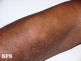 leprosy indeterminate