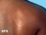leprosy indeterminate