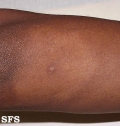 leprosy indeterminate