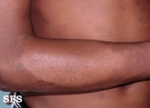 leprosy indeterminate
