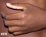 leprosy indeterminate