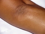 leprosy indeterminate