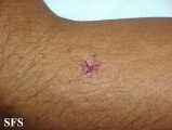 leprosy indeterminate