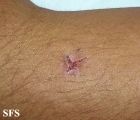 leprosy indeterminate