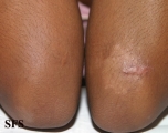 leprosy indeterminate