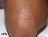 leprosy indeterminate