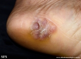 keloid