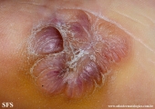 keloid