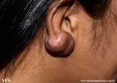 keloid
