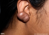 keloid