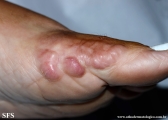 keloid