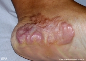 keloid