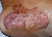 keloid