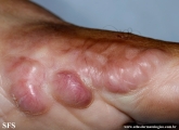 keloid