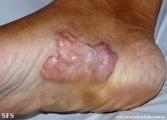 keloid