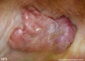 keloid