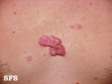 keloid
