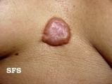 keloid