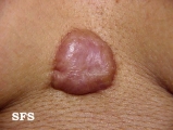 keloid