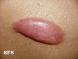 keloid