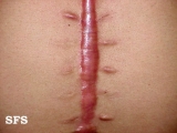 keloid