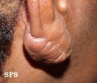 keloid