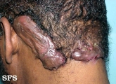 keloid