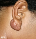 keloid