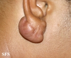 keloid